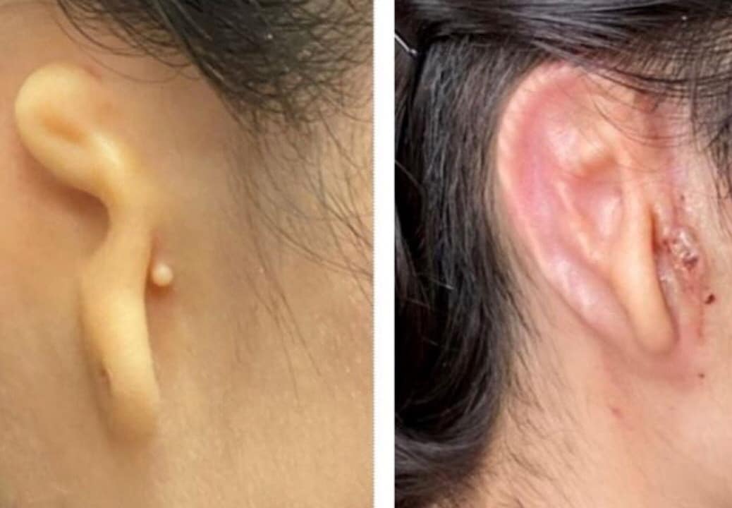 3D baskı yoluyla üretilen kulak bir hastaya nakledildi